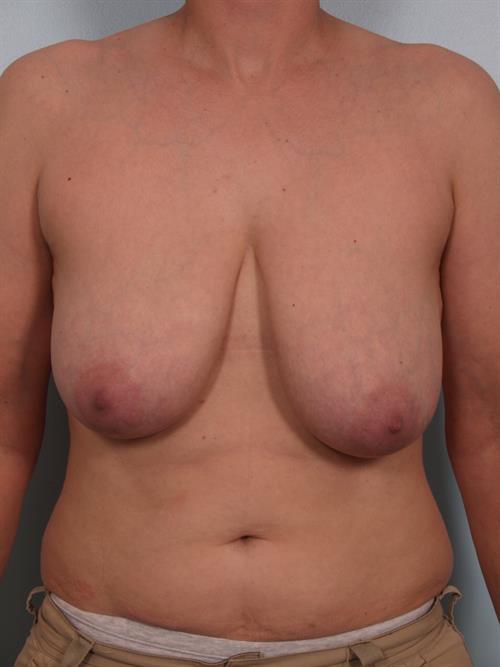 Breast Reduction Before Photo | Phoenix and Scottsdale, AZ | Scottsdale Center for Plastic Surgery