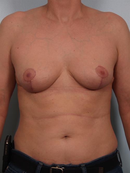 Breast Reduction After Photo | Phoenix and Scottsdale, AZ | Scottsdale Center for Plastic Surgery