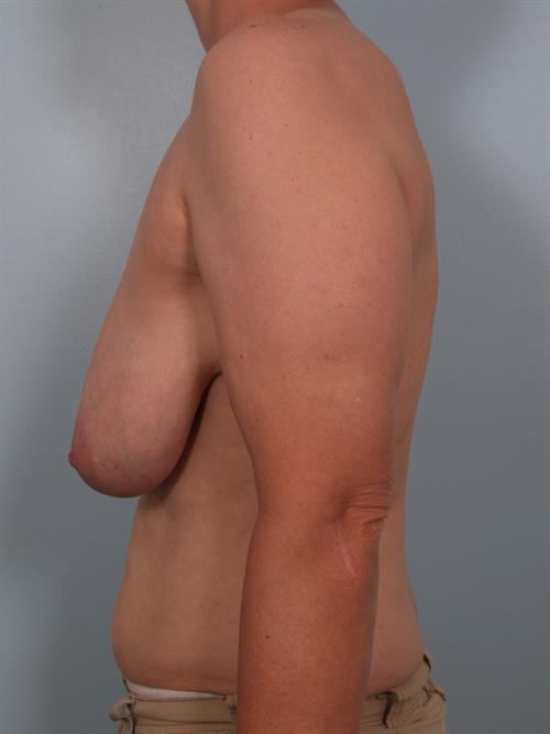 Breast Reduction Before Photo | Phoenix and Scottsdale, AZ | Scottsdale Center for Plastic Surgery