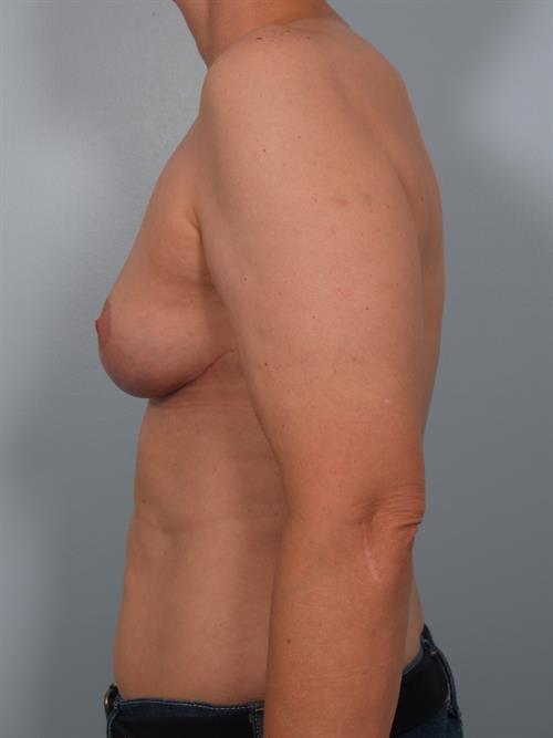 Breast Reduction After Photo | Phoenix and Scottsdale, AZ | Scottsdale Center for Plastic Surgery