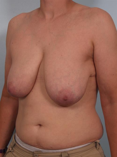 Breast Reduction Before Photo | Phoenix and Scottsdale, AZ | Scottsdale Center for Plastic Surgery