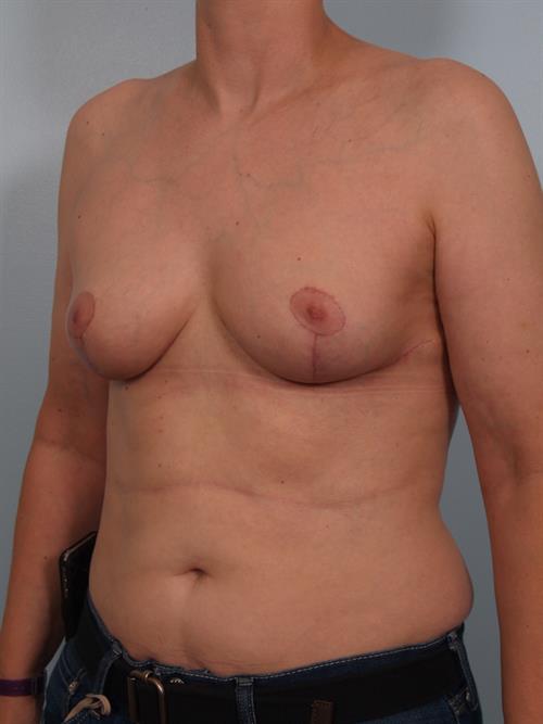 Breast Reduction After Photo | Phoenix and Scottsdale, AZ | Scottsdale Center for Plastic Surgery
