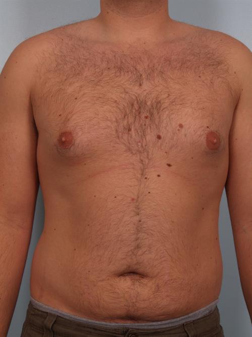 Male Breast/Areola Reduction Before Photo | ,  | 