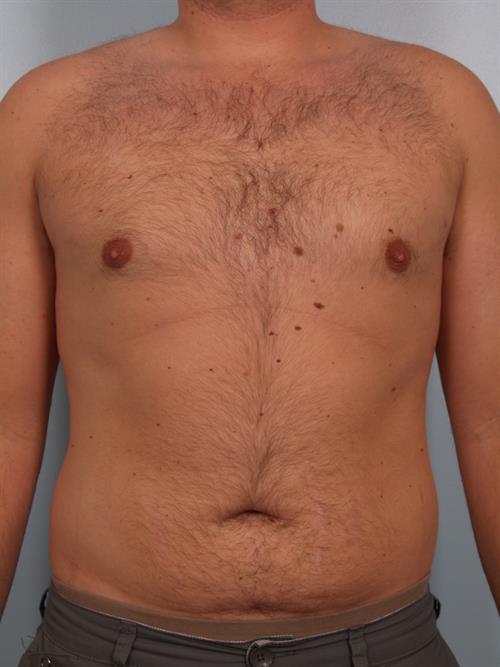 Male Breast/Areola Reduction After Photo | Phoenix and Scottsdale, AZ | Scottsdale Center for Plastic Surgery