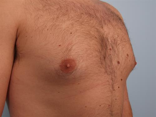 Male Breast/Areola Reduction Before Photo | Phoenix and Scottsdale, AZ | Scottsdale Center for Plastic Surgery