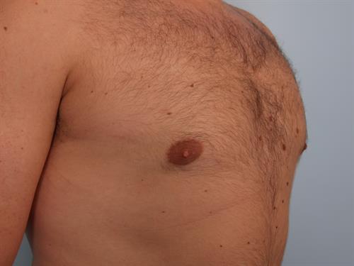 Male Breast/Areola Reduction After Photo | Phoenix and Scottsdale, AZ | Scottsdale Center for Plastic Surgery