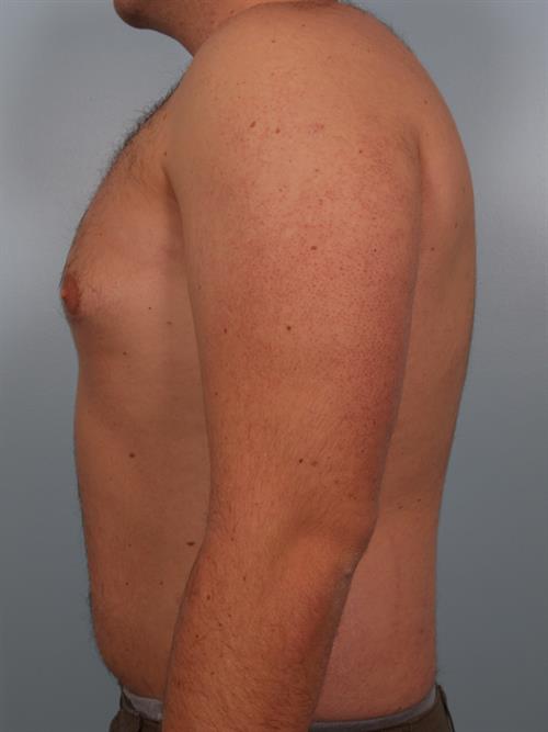 Male Breast/Areola Reduction Before Photo | Phoenix and Scottsdale, AZ | Scottsdale Center for Plastic Surgery