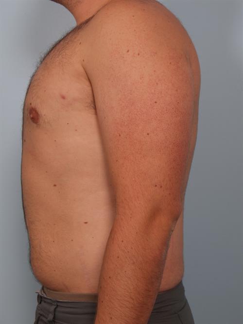 Male Breast/Areola Reduction After Photo | Phoenix and Scottsdale, AZ | Scottsdale Center for Plastic Surgery