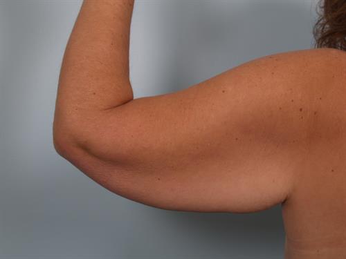 Brachioplasty (Arm Lift) Before Photo | Phoenix and Scottsdale, AZ | Scottsdale Center for Plastic Surgery