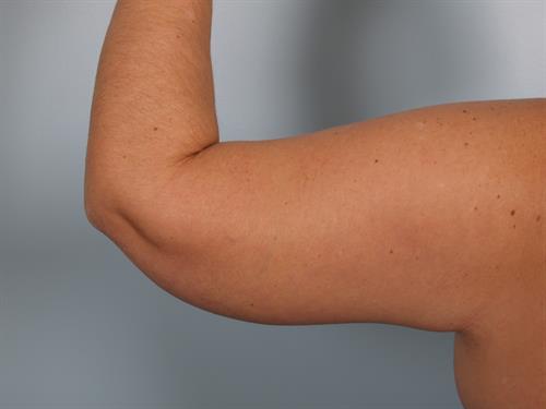 Brachioplasty (Arm Lift) After Photo | Phoenix and Scottsdale, AZ | Scottsdale Center for Plastic Surgery