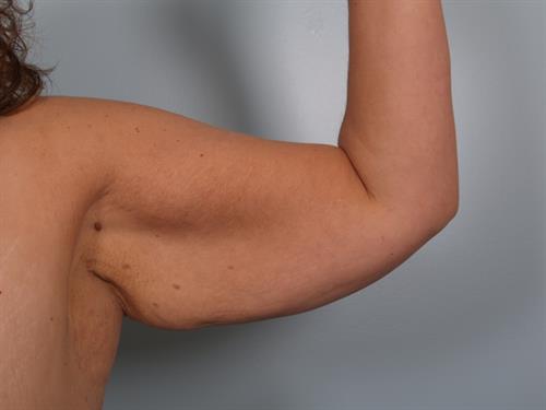Brachioplasty (Arm Lift) Before Photo | Phoenix and Scottsdale, AZ | Scottsdale Center for Plastic Surgery