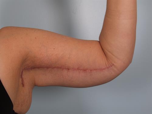 Brachioplasty (Arm Lift) After Photo | Phoenix and Scottsdale, AZ | Scottsdale Center for Plastic Surgery