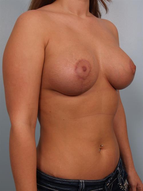 Breast Lift (Mastopexy) with Implants After Photo | Phoenix and Scottsdale, AZ | Scottsdale Center for Plastic Surgery