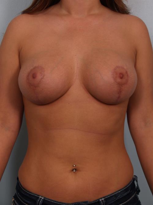 Breast Lift (Mastopexy) with Implants After Photo | Phoenix and Scottsdale, AZ | Scottsdale Center for Plastic Surgery