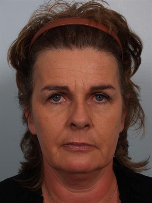 Botox Before Photo | Phoenix and Scottsdale, AZ | Scottsdale Center for Plastic Surgery