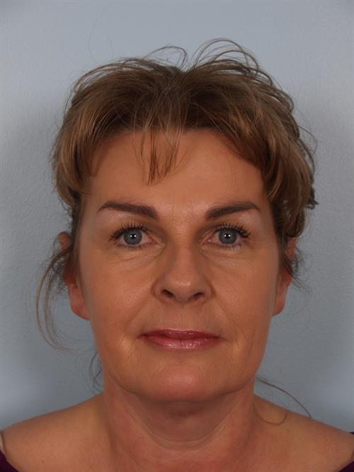 Botox After Photo | ,  | 