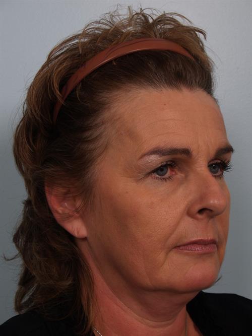 Brow Lift Before Photo | ,  | 
