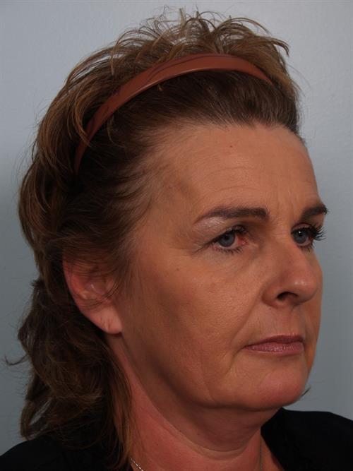 Botox Before Photo | Phoenix and Scottsdale, AZ | Scottsdale Center for Plastic Surgery