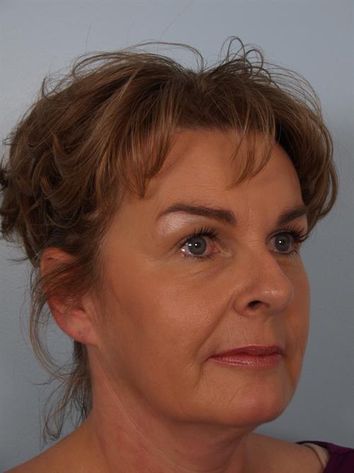 Botox After Photo | Phoenix and Scottsdale, AZ | Scottsdale Center for Plastic Surgery