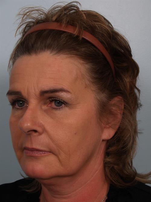 Botox Before Photo | Phoenix and Scottsdale, AZ | Scottsdale Center for Plastic Surgery