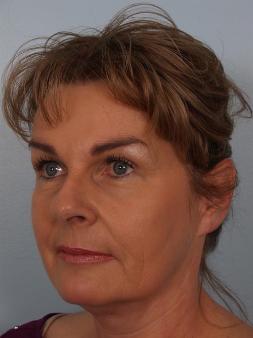 Botox After Photo | Phoenix and Scottsdale, AZ | Scottsdale Center for Plastic Surgery