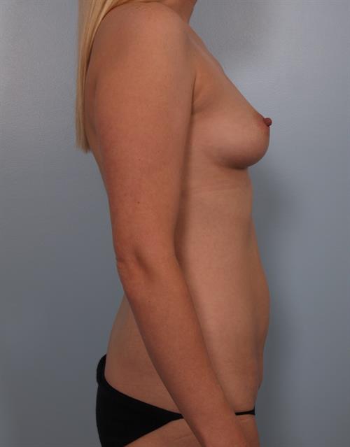 Breast Augmentation Before Photo | Phoenix and Scottsdale, AZ | Scottsdale Center for Plastic Surgery