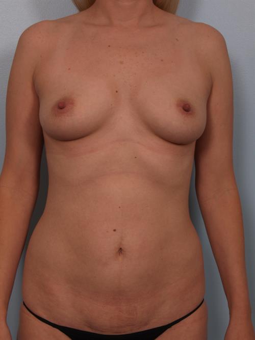 Breast Augmentation Before Photo | Phoenix and Scottsdale, AZ | Scottsdale Center for Plastic Surgery