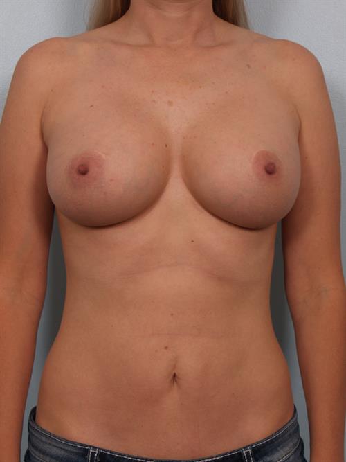 Tummy Tuck After Photo | ,  | 