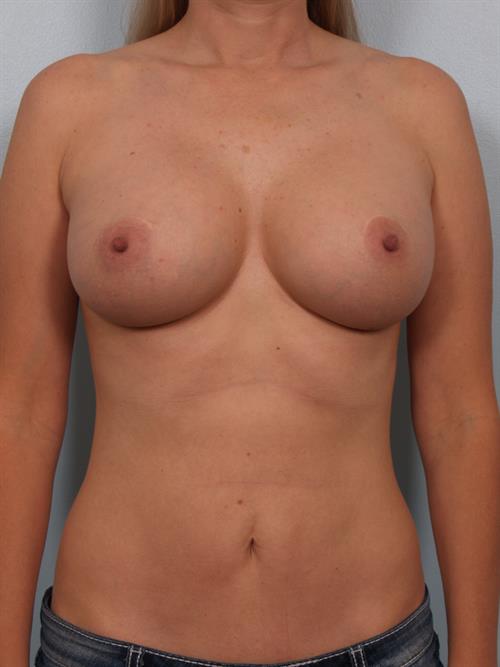Breast Augmentation After Photo | Phoenix and Scottsdale, AZ | Scottsdale Center for Plastic Surgery