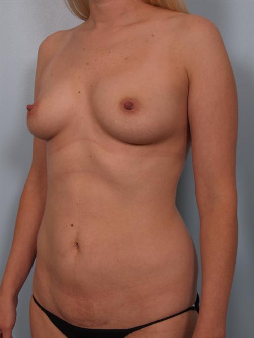Breast Augmentation Before Photo | Phoenix and Scottsdale, AZ | Scottsdale Center for Plastic Surgery