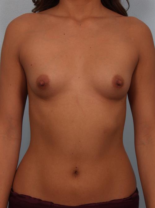 Breast Augmentation Before Photo | Phoenix and Scottsdale, AZ | Scottsdale Center for Plastic Surgery