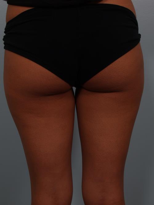 Power Assisted Liposuction Before Photo | Phoenix and Scottsdale, AZ | Scottsdale Center for Plastic Surgery