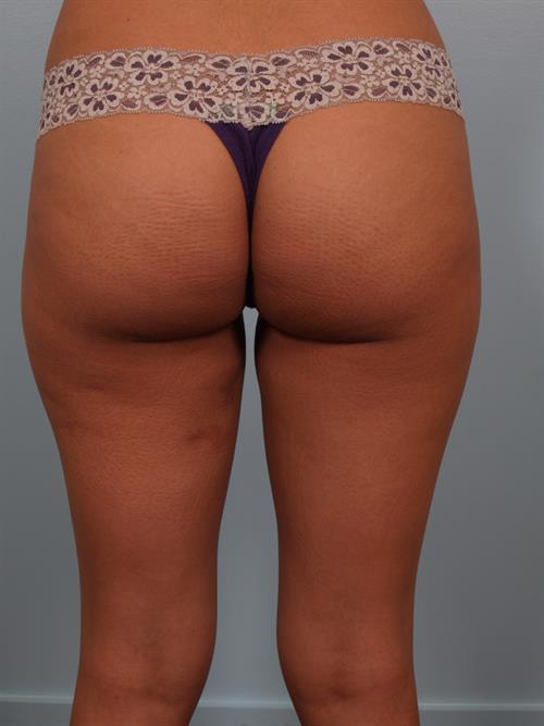 Power Assisted Liposuction After Photo | Phoenix and Scottsdale, AZ | Scottsdale Center for Plastic Surgery