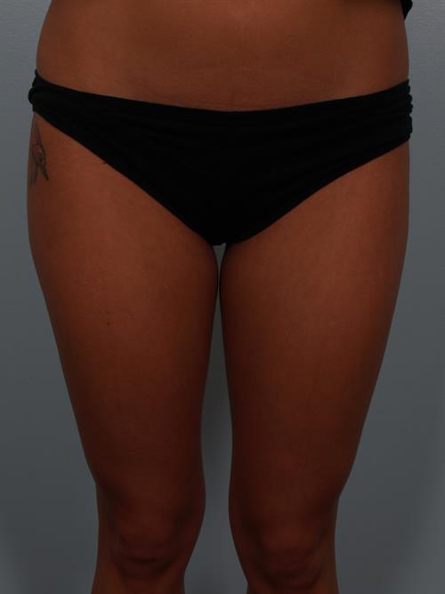 Power Assisted Liposuction Before Photo | Phoenix and Scottsdale, AZ | Scottsdale Center for Plastic Surgery