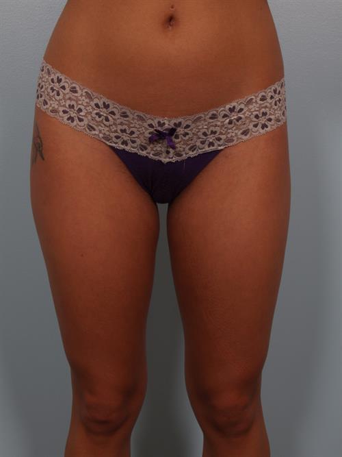 Power Assisted Liposuction After Photo | Phoenix and Scottsdale, AZ | Scottsdale Center for Plastic Surgery