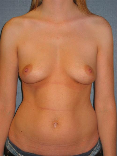 Breast Augmentation Before Photo | Phoenix and Scottsdale, AZ | Scottsdale Center for Plastic Surgery