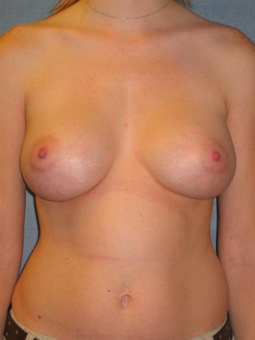 Breast Augmentation After Photo | Phoenix and Scottsdale, AZ | Scottsdale Center for Plastic Surgery