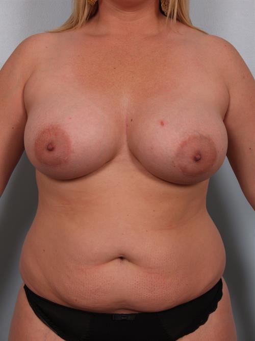 Revision Breast Surgery Before Photo | Phoenix and Scottsdale, AZ | Scottsdale Center for Plastic Surgery