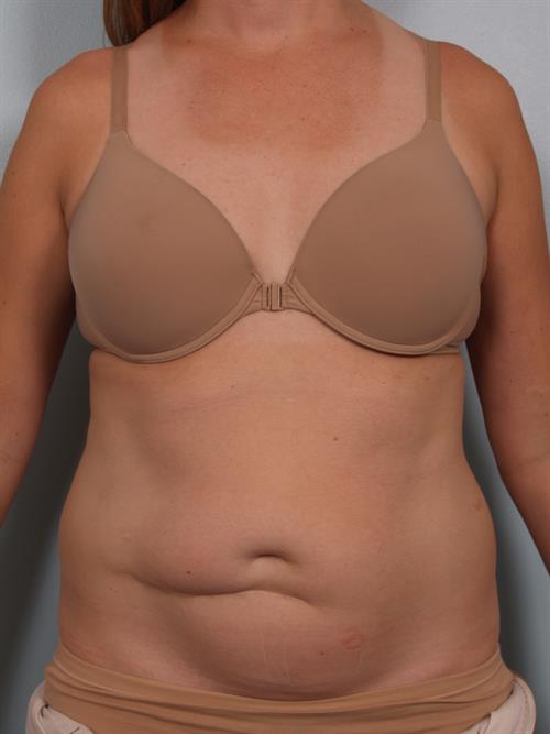 Tummy Tuck Before Photo | Phoenix and Scottsdale, AZ | Scottsdale Center for Plastic Surgery