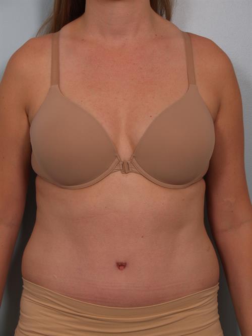 Tummy Tuck After Photo | Phoenix and Scottsdale, AZ | Scottsdale Center for Plastic Surgery
