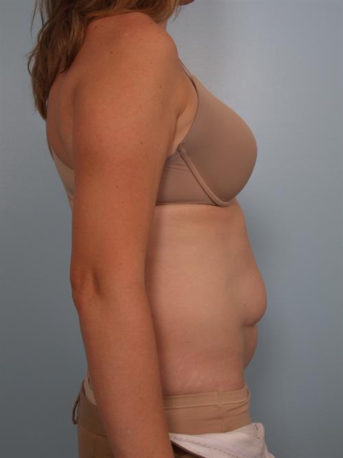Tummy Tuck Before Photo | Phoenix and Scottsdale, AZ | Scottsdale Center for Plastic Surgery