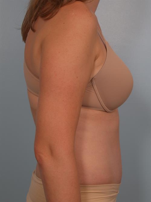 Tummy Tuck After Photo | Phoenix and Scottsdale, AZ | Scottsdale Center for Plastic Surgery