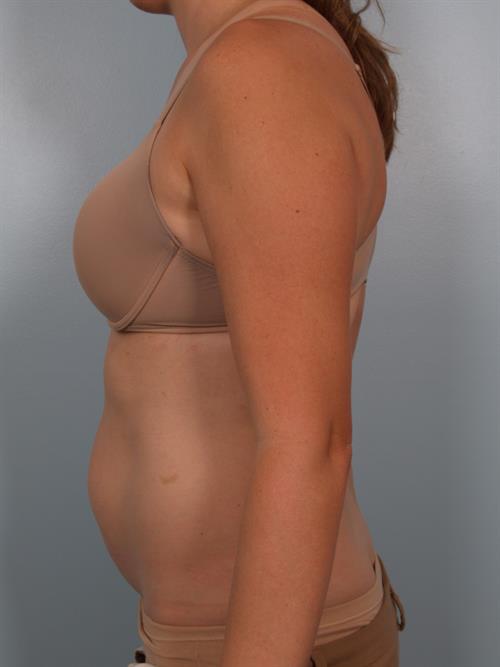 Tummy Tuck Before Photo | Phoenix and Scottsdale, AZ | Scottsdale Center for Plastic Surgery