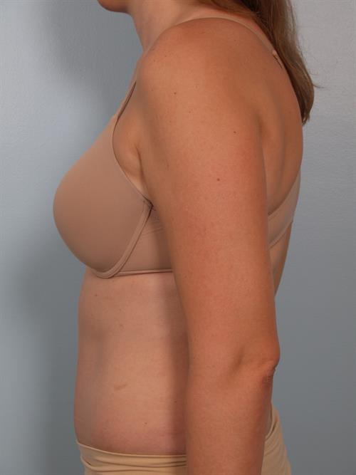 Tummy Tuck After Photo | Phoenix and Scottsdale, AZ | Scottsdale Center for Plastic Surgery