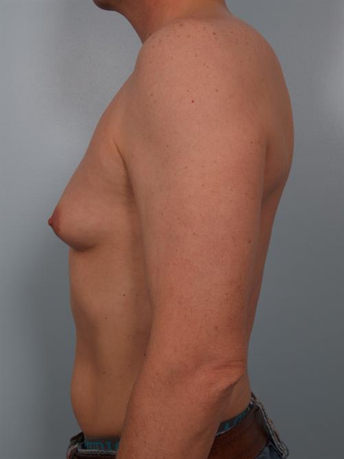 Male Liposuction Before Photo | Phoenix and Scottsdale, AZ | Scottsdale Center for Plastic Surgery