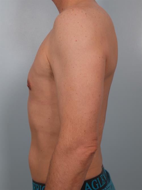 Male Liposuction After Photo | Phoenix and Scottsdale, AZ | Scottsdale Center for Plastic Surgery