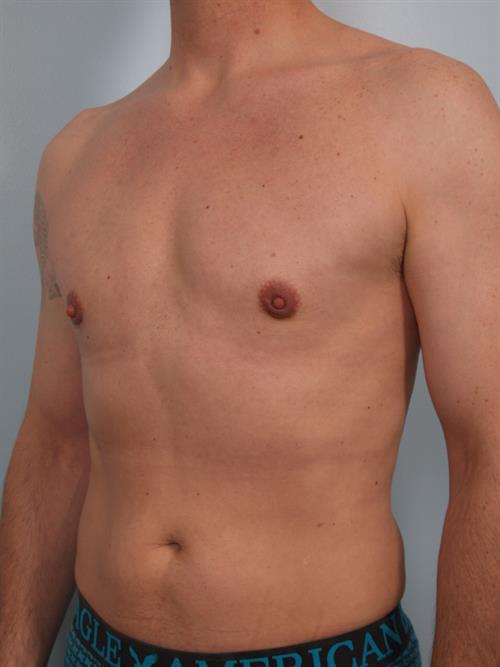 Male Breast/Areola Reduction After Photo | Phoenix and Scottsdale, AZ | Scottsdale Center for Plastic Surgery
