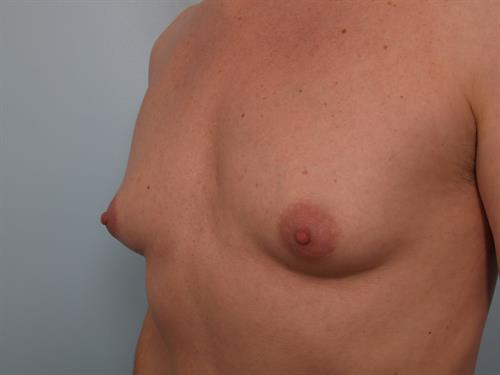 Male Breast/Areola Reduction Before Photo | Phoenix and Scottsdale, AZ | Scottsdale Center for Plastic Surgery