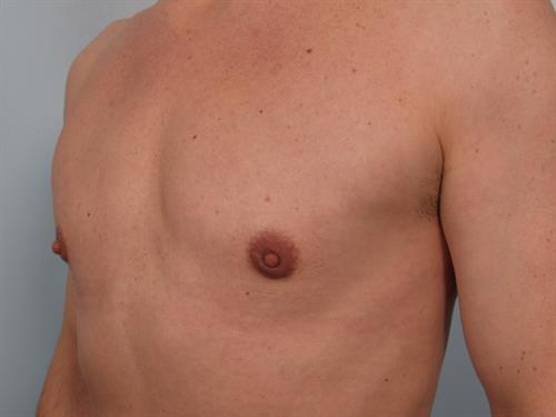 Male Breast/Areola Reduction After Photo | Phoenix and Scottsdale, AZ | Scottsdale Center for Plastic Surgery