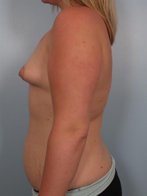 Breast Augmentation Before Photo | Phoenix and Scottsdale, AZ | Scottsdale Center for Plastic Surgery